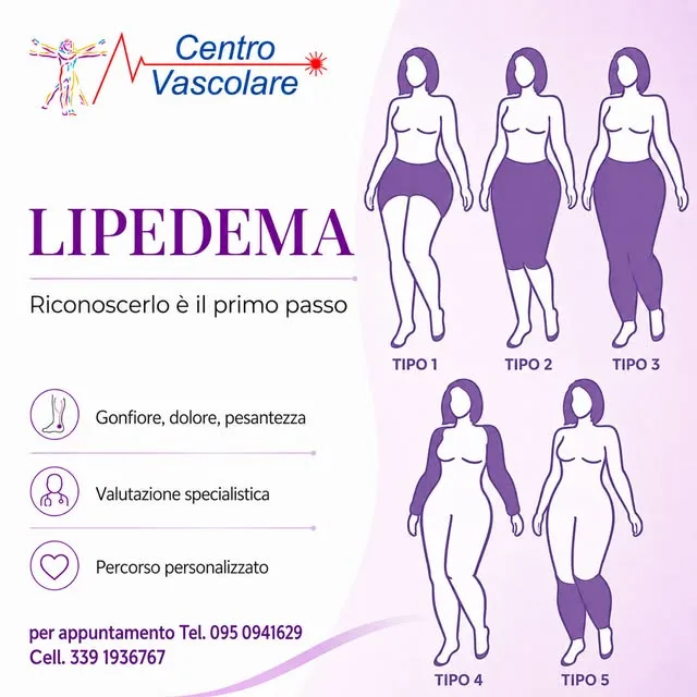 Locandina sul lipedema: i cinque tipi e i segnali per riconoscerlo