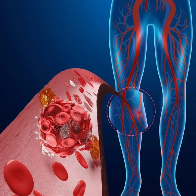 Illustrazione di un trombo in una vena della gamba