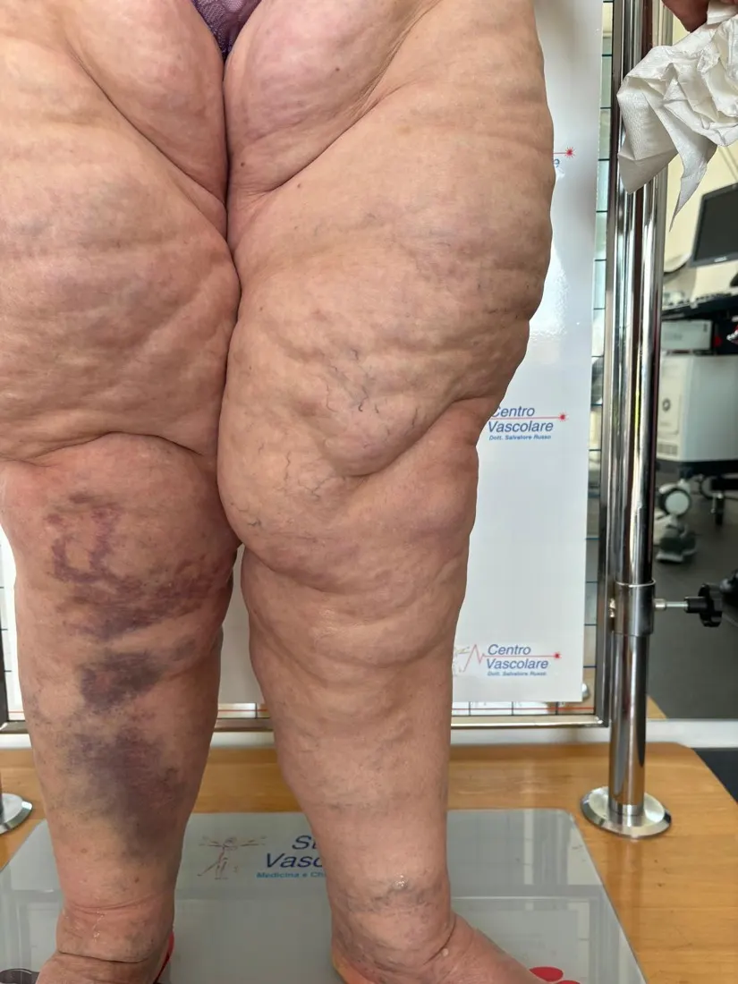 Gambe con lipedema e lividi ed ecchimosi visibili