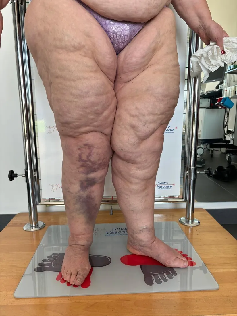 Gambe di una paziente con lipedema viste di fronte, con ecchimosi