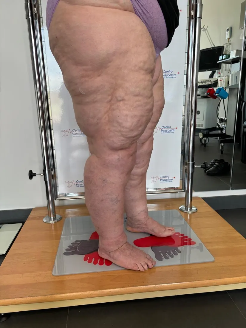 Gambe di una paziente con lipedema viste di lato durante la visita