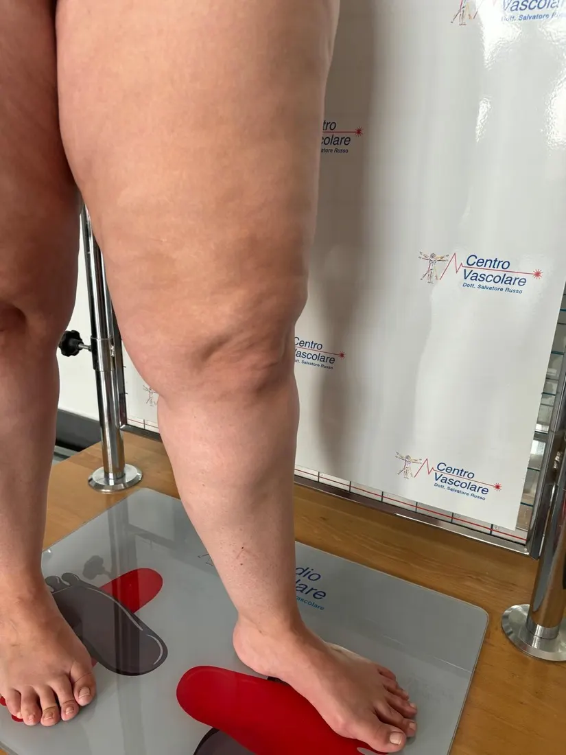 Profilo di coscia e gamba in una paziente con lipedema