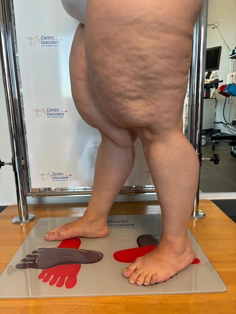 Gambe di una paziente con lipedema viste di lato, senza interessamento dei piedi