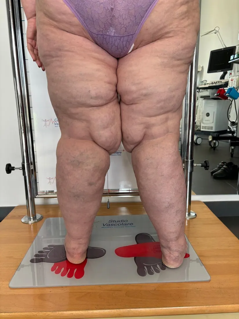 Gambe di una paziente con lipedema viste da dietro