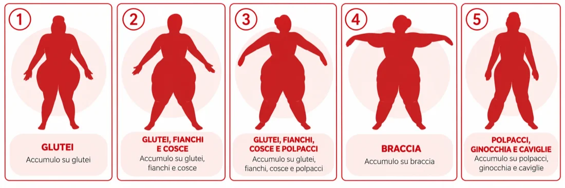 I cinque tipi di lipedema in base alla sede: 1 glutei; 2 glutei, fianchi e cosce; 3 glutei, fianchi, cosce e polpacci; 4 braccia; 5 polpacci, ginocchia e caviglie.