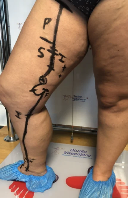 Gamba vista di lato con il mappaggio emodinamico disegnato sulla pelle con penna dermografica