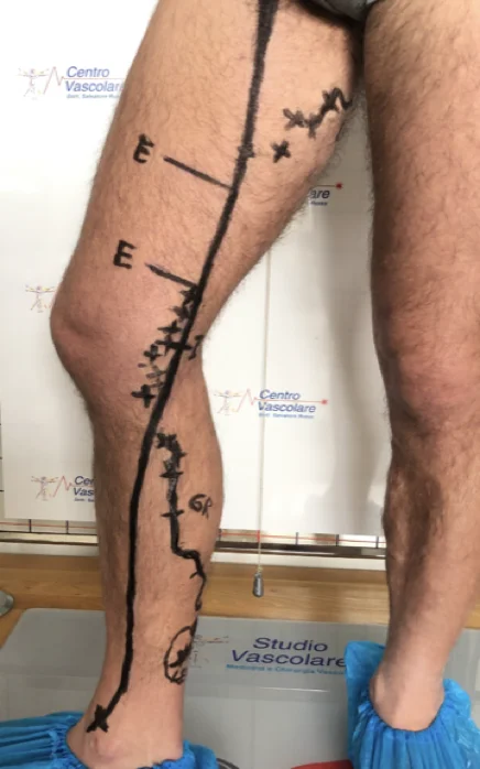 Gamba vista di lato con i punti del mappaggio emodinamico segnati sulla pelle