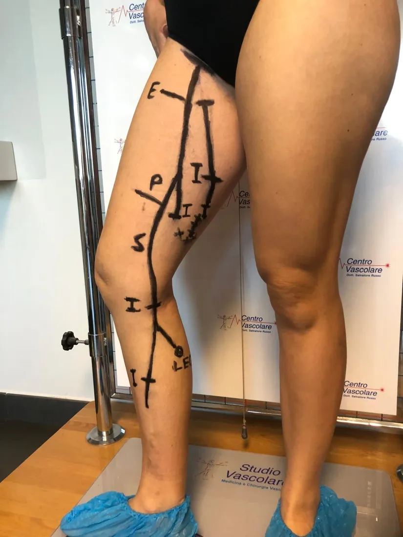 Gamba vista di lato con le linee e le sigle del mappaggio emodinamico sulla pelle