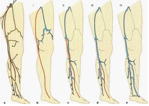 Schema della gamba con cinque disegni (da a a e) che mostrano diversi quadri emodinamici, numerati da I a IV, e i decorsi incontinenti dei vasi