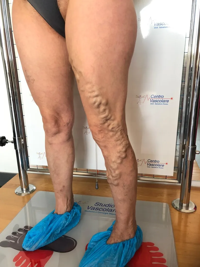 Gambe viste da davanti con varici voluminose sulla coscia e sul polpaccio